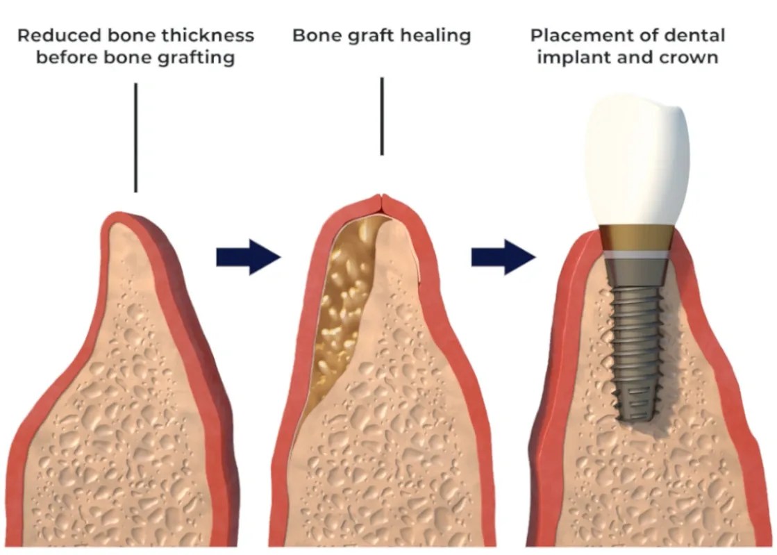illustration of onlay bone graft
