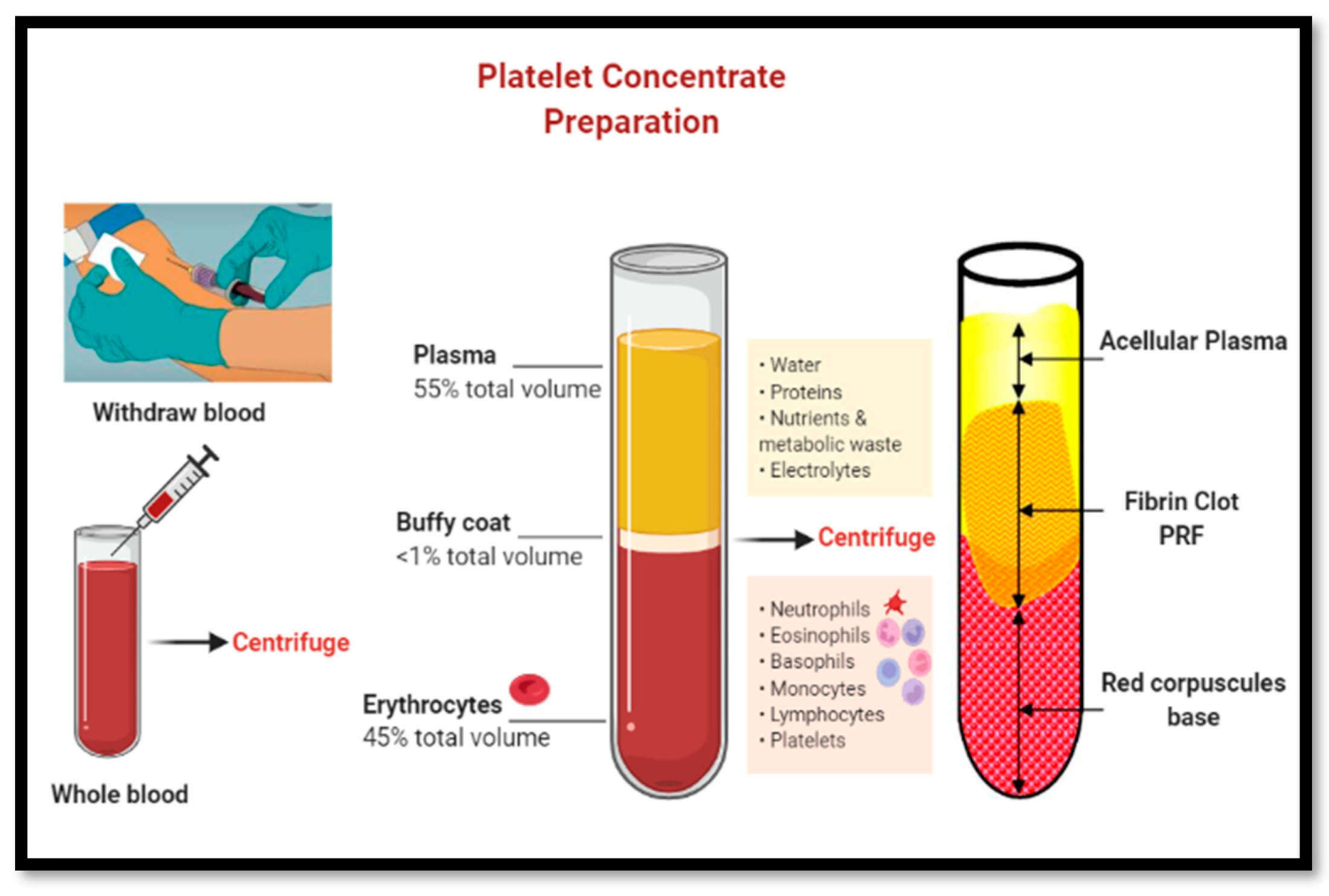 platelet rich fibrin demonstration